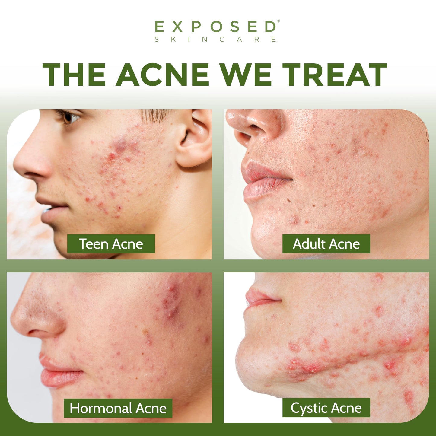 Exposed Skin Care Clearing Tonic – 1% Salicylic Acid & Witch Hazel, Acne Toner