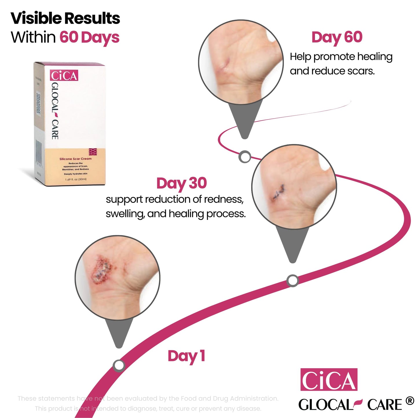 GlocalCare CICA Scar Cream – Silicone Scar Treatment for New & Old Scars, PIH & Stretch Marks (50 ml)