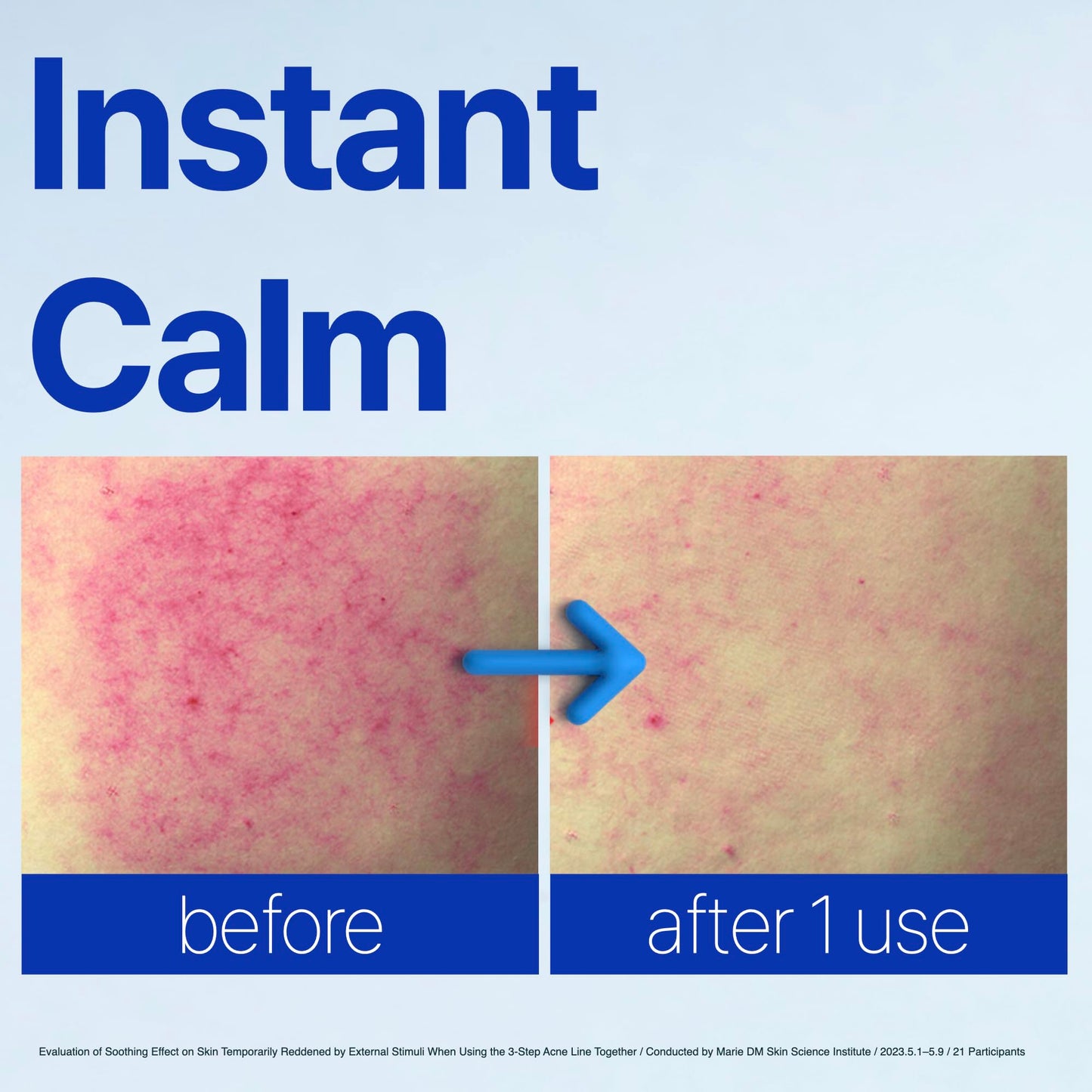 ISOI ACNI Dr. 1st Speedy Gel Cream – Oil-Free Hydrating Gel for Oily & Sensitive Skin (50ml)