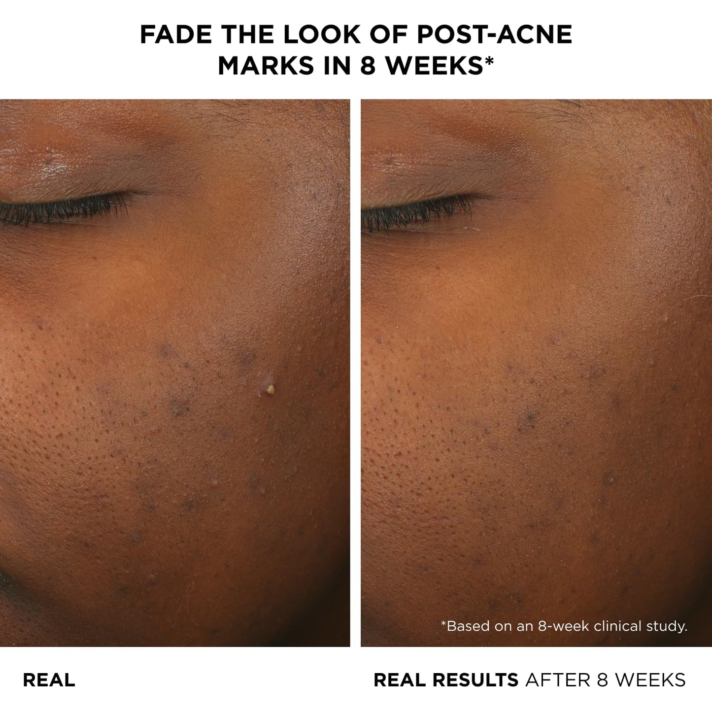 IT Cosmetics Bye Bye Breakout Acne Serum — 2% Salicylic + 3% Lactic Acid