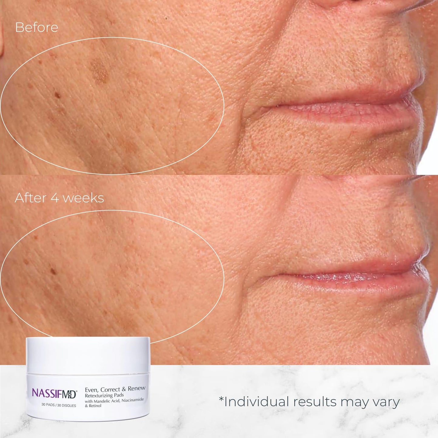 NassifMD Even, Correct & Renew Retexturizing Pads | Facial Peel for Texture & Tone