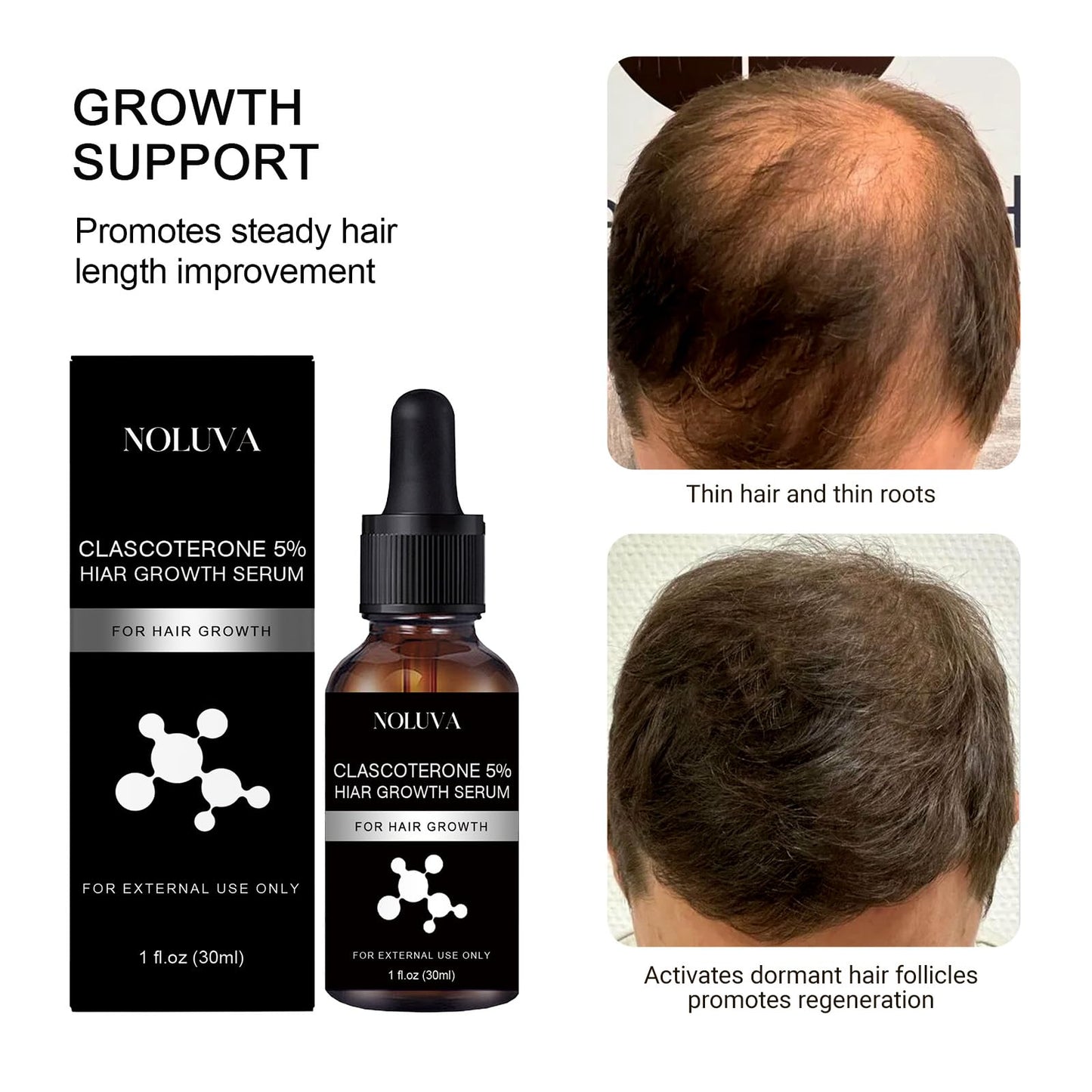 NOLUVA CLASCOTERONE 5% Hair Restoration Serum – Vitamin D, Minoxidil & Biotin (30ml)