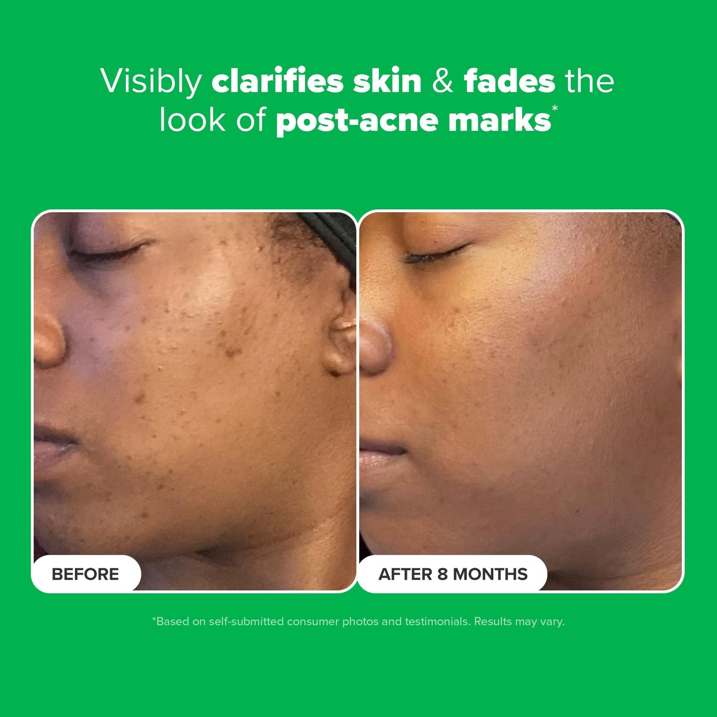 Paula's Choice BOOST 10% Azelaic Acid Booster Cream-Gel – Oil-Free Serum with Salicylic Acid