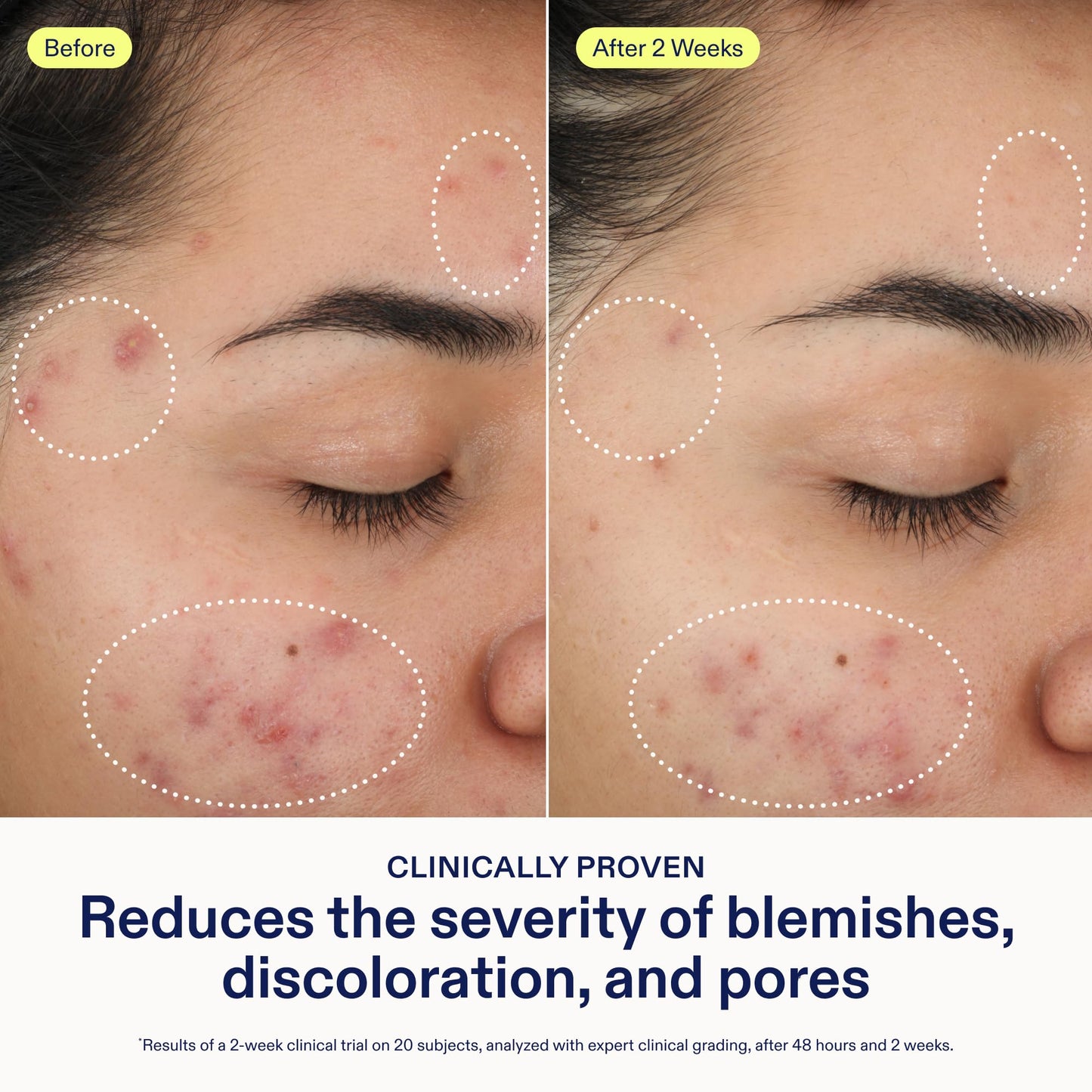 Skinfix 2% BHA Cleanser - Fragrance-Free Acne Care for All Skin Types (5 oz) | Vegan & Cruelty-Free