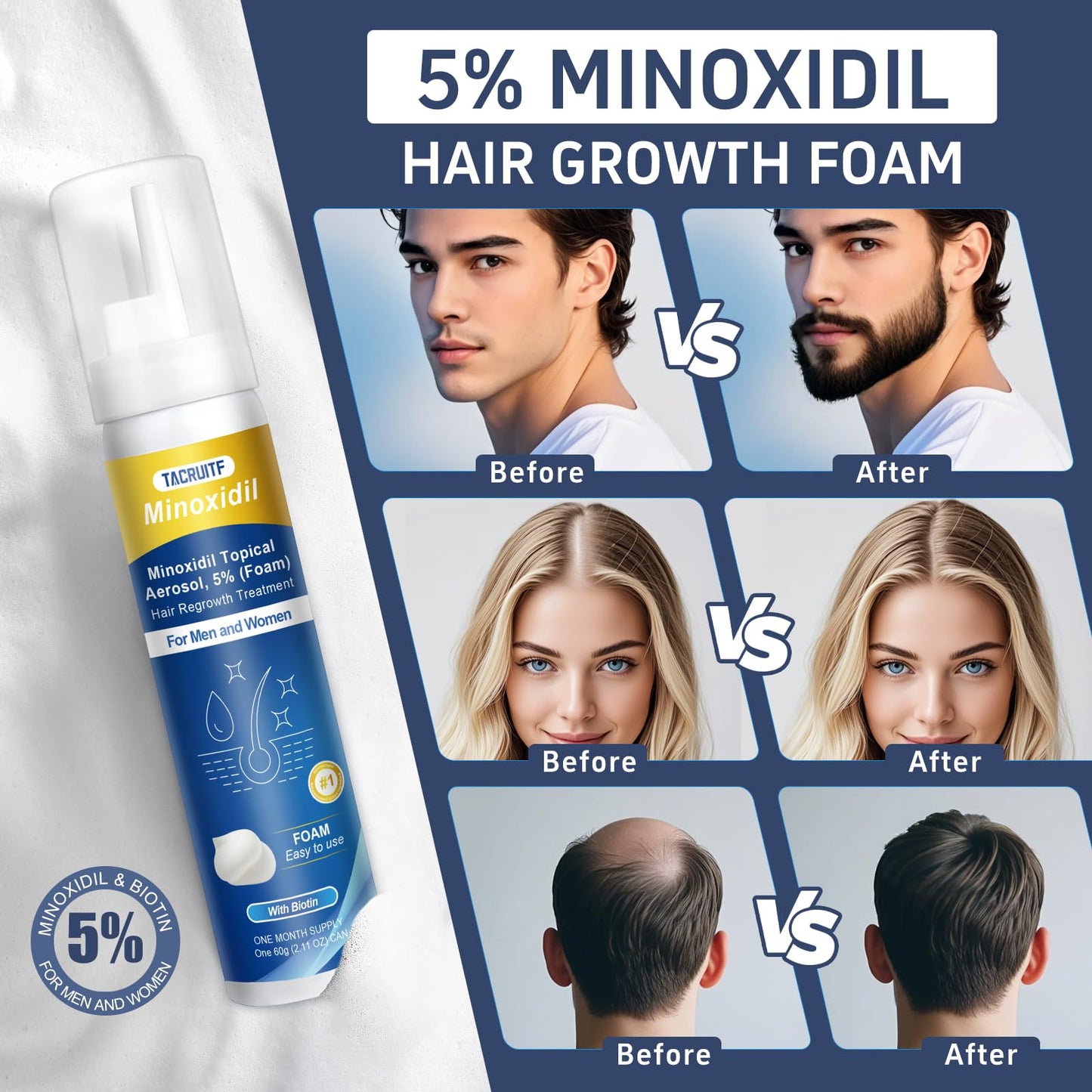 Tacruitf 4-Pack Minoxidil Foam 5% – Hair & Beard Growth, Biotin-Infused, 8.44 oz