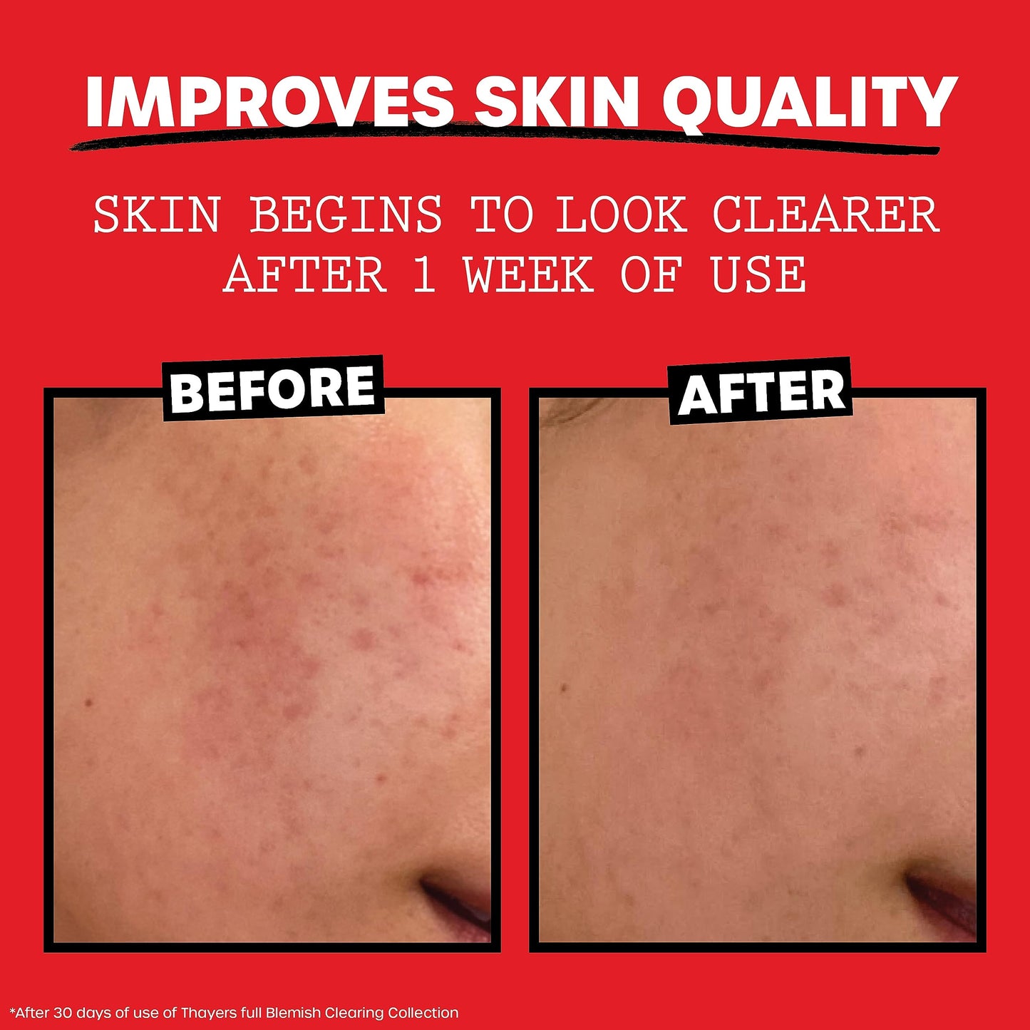 THAYERS Witch Hazel Blemish Cleanser, 4 oz  2% Salicylic Acid