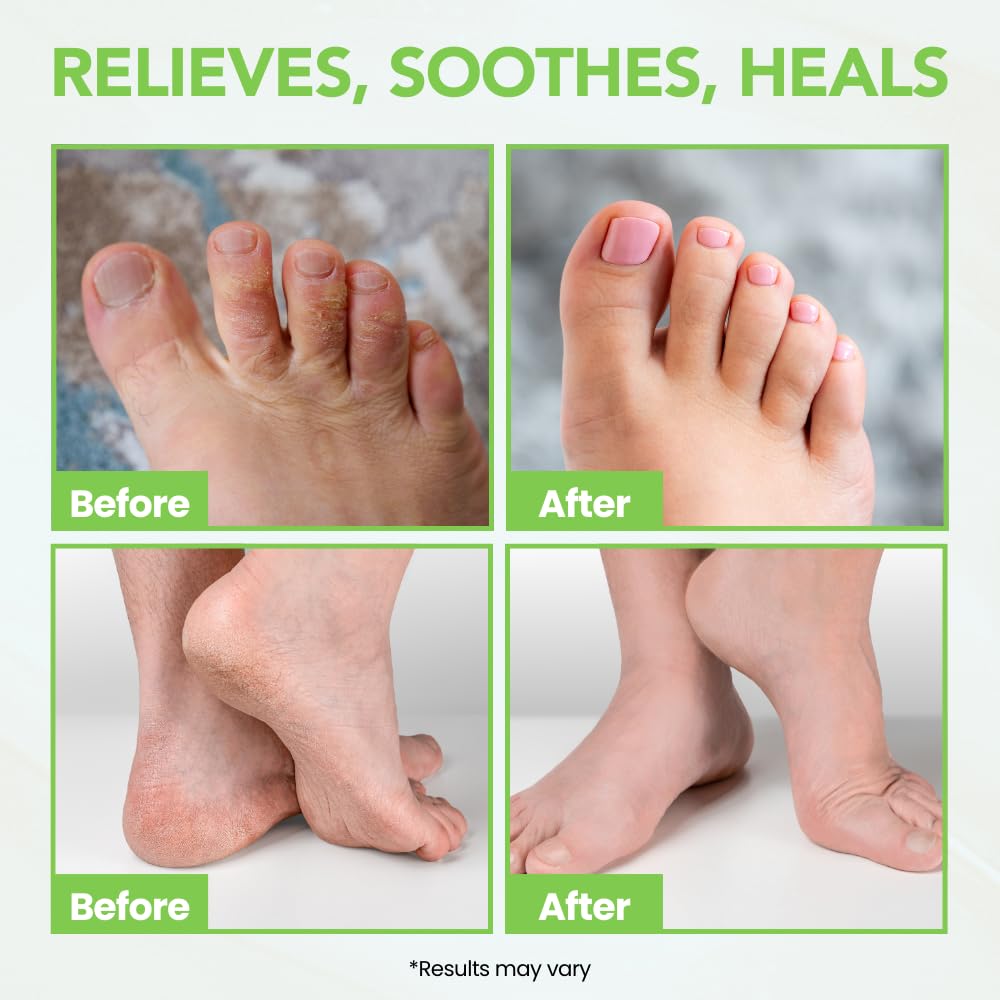 Thena Athletes Foot Cream Extra Strength Herbal Relief – Tea Tree, Neem & Menthol | THENA Natural Wellness