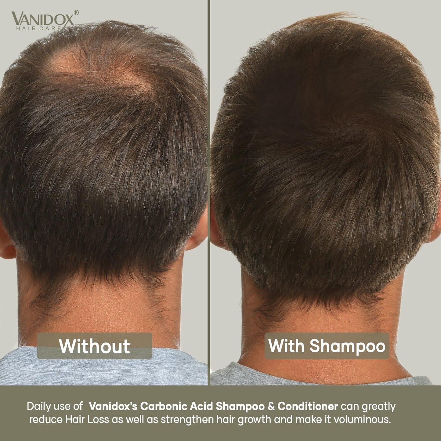 VANIDOX Carbonic Acid Shampoo & Conditioner Set — Deep Moisture, Volume & Scalp Nourishment | Made in USA